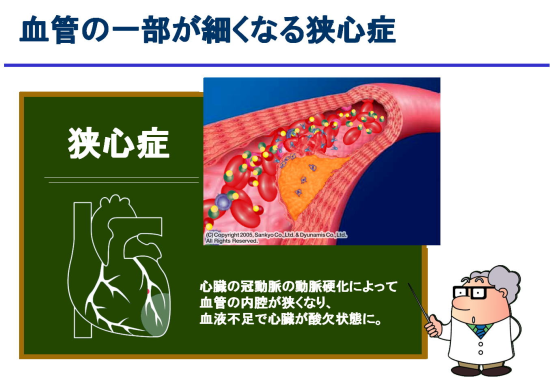 狭心症